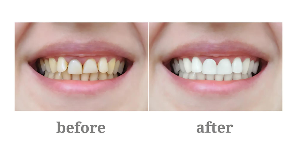 Invisalign Treatment