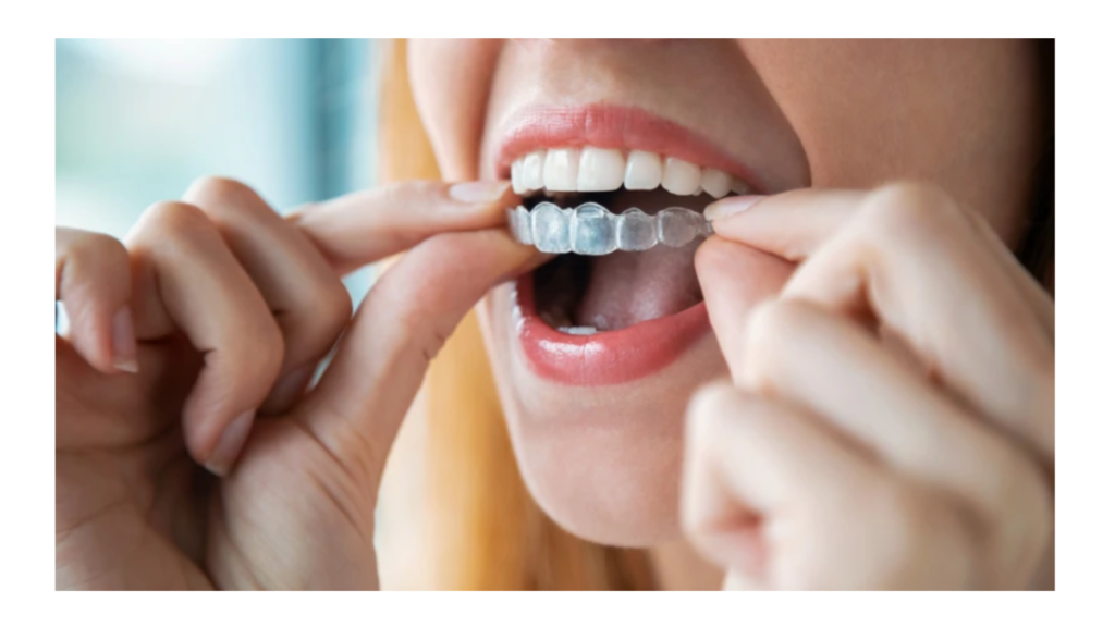 Plastic Clear Aligners