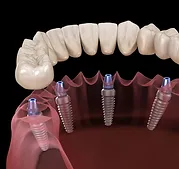 Implant Fixed Full-arch Supported Bridges