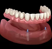 Denture Stabilization implant Treatment