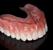 Implant Supported Overdenture removable